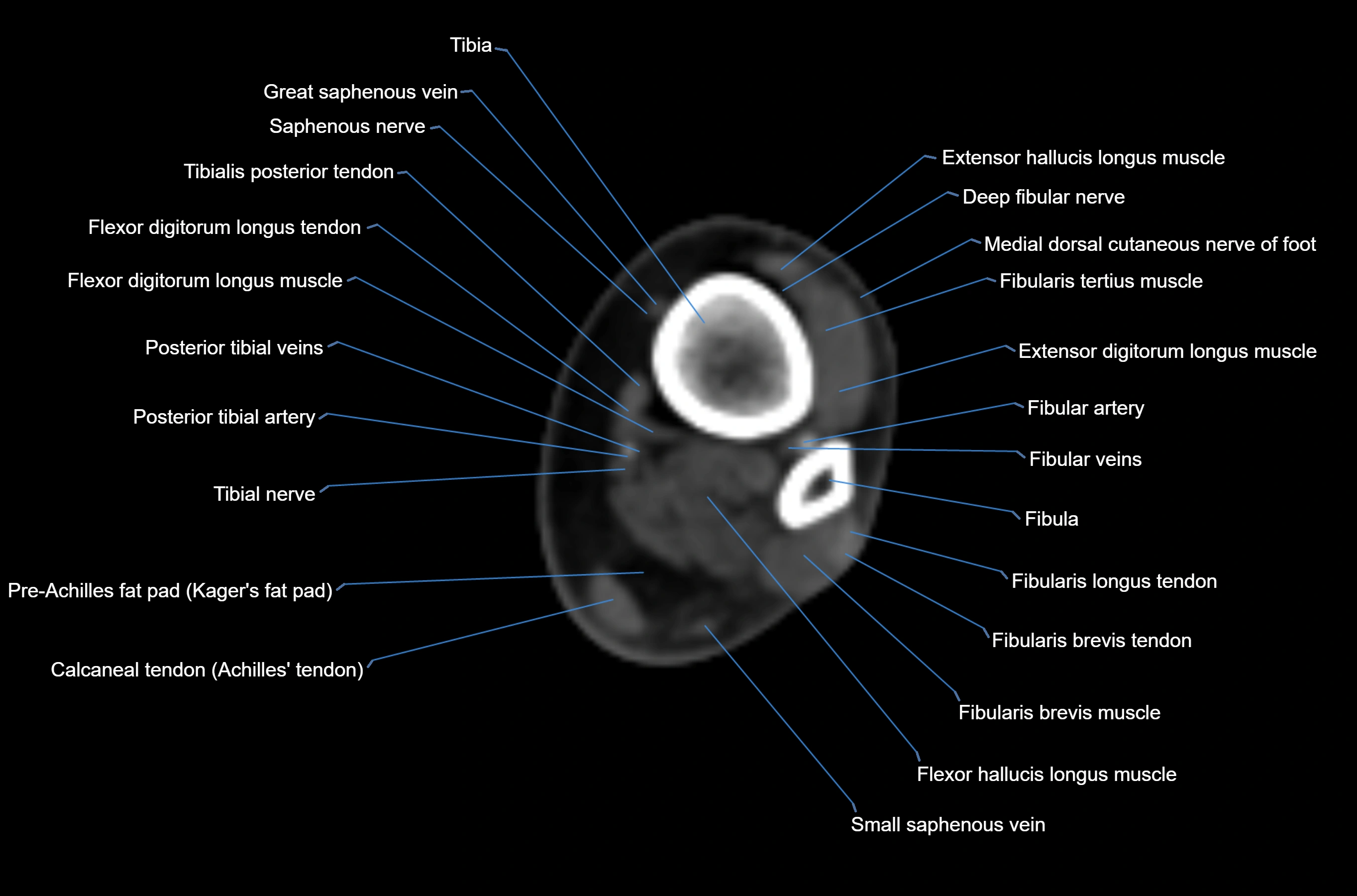 CT Ankle axial cross sectional anatomy labelled image -00016.webp